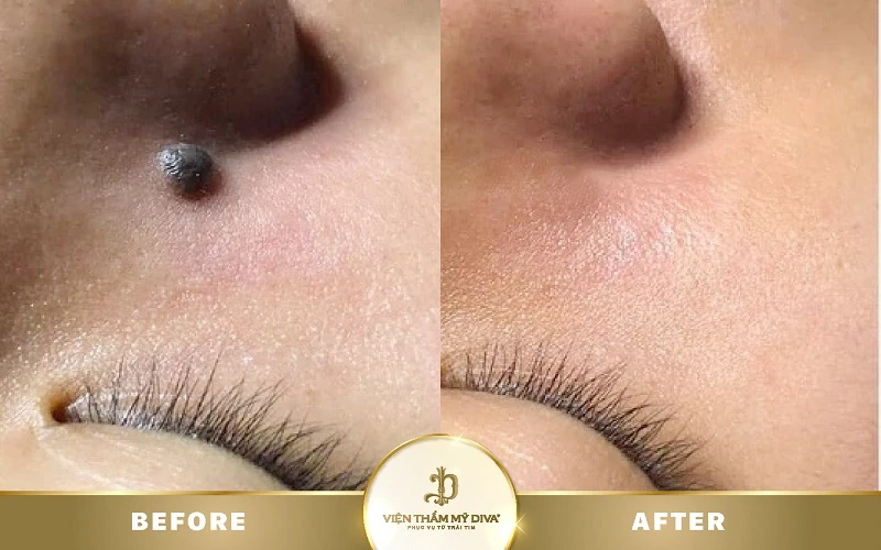 Nốt ruồi ở ngón chân út có ý nghĩa gì? Tướng số Tốt/ Xấu? 7