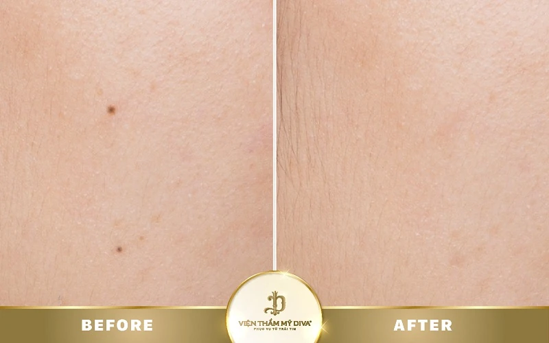 Nốt ruồi ở ngón chân út có ý nghĩa gì? Tướng số Tốt/ Xấu? 9 Nốt ruồi ở ngón chân út có ý nghĩa gì? Tướng số Tốt/ Xấu? 9