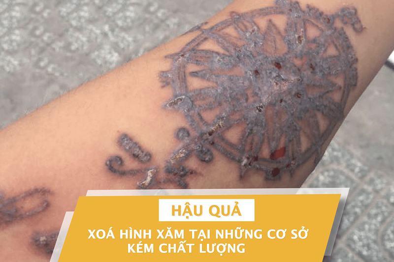 Xóa xăm tại nơi kém chất lượng gây ra sẹo