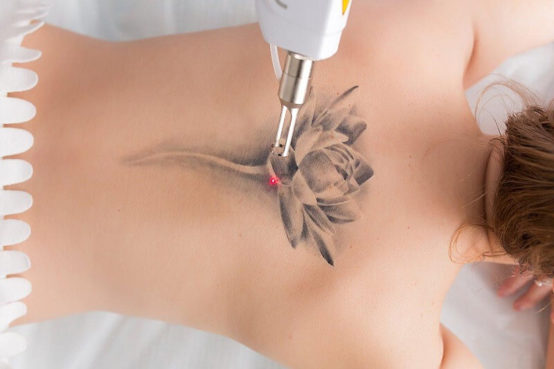 xóa xăm taị thủ dầu một