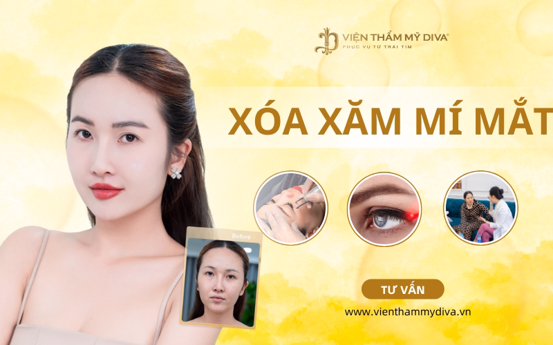 Xóa xăm mí mắt an toàn, hiệu quả với công nghệ mới nhất 2025