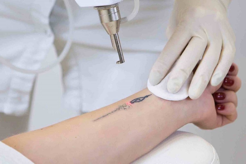 Tiêu chí để lựa chọn địa chỉ xóa xăm uy tín, chất lượng nhất hiện nay