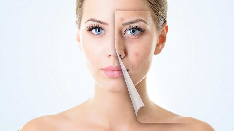 Tiêu chí lựa chọn cơ sở trị mụn tốt nhất hiện nay